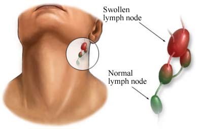 Swollen & Tender Lymph Nodes – Central Sensitivity
